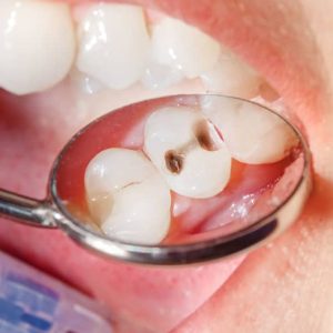 broken-tooth-1000x563-1